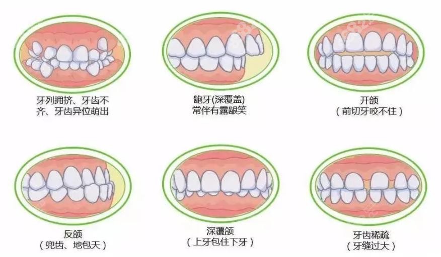 西安瑞泰口腔做牙齒矯正具體價格多少要結合牙齒實際問題而定