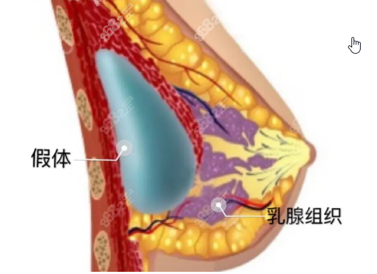 假体隆胸内部结构图