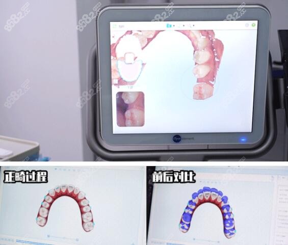 齿度口腔iTero模拟器扫描