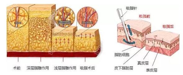 上海华美何斌医生面部吸脂怎么样