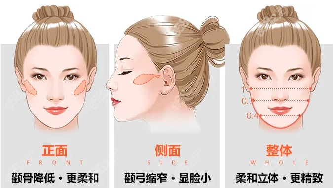 上海李湘原颧骨内推怎么样？