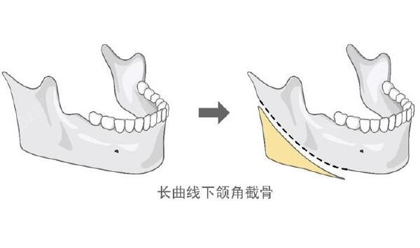 李志海做下颌角手术好吗