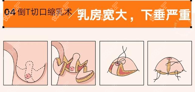 倒T形切开法缩胸