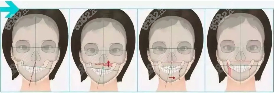 <!--<i data=20240705-sp></i>-->正颌手术会亲自做吗？