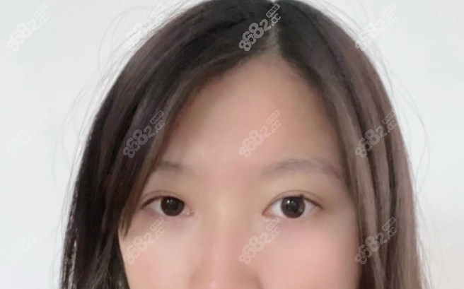 聶麗麗雙眼皮真實(shí)案 例1