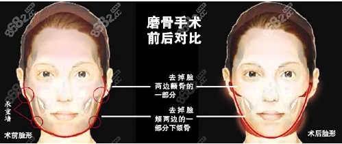 上海李湘原磨骨技术就是好