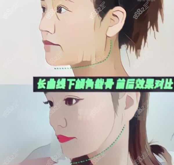 李志海做的长曲线下颌角磨骨真人对比照