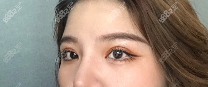 聶麗麗雙眼皮真實(shí)案 例2