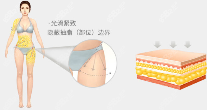 北京京韩吸脂手术隐痕