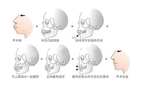 <!--<i data=20240705-sp></i>-->操作正颌手术示意图