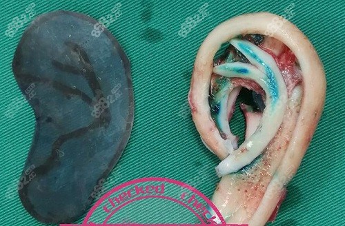 沈干医生用肋骨雕刻的耳朵形状