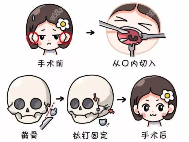 上海李湘原做颧骨内推展示图