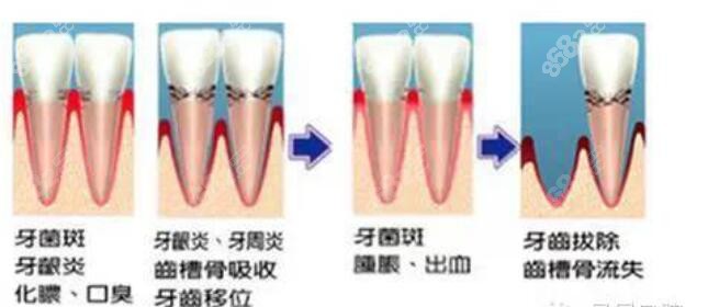 牙周炎种牙
