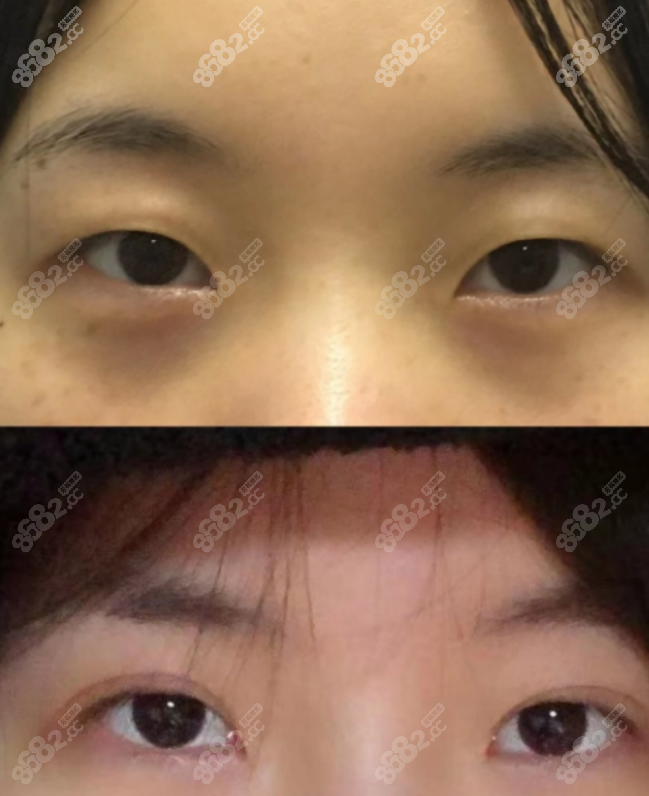 同济陈平割双眼皮如何从双眼皮修复的案例来看做的挺好