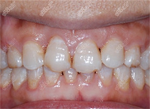 深圳同步齒科矯正后