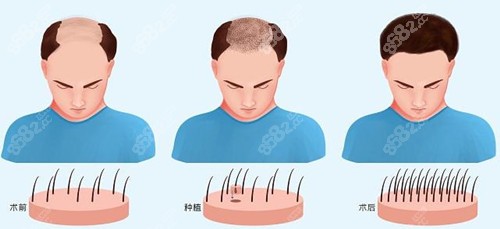 碧莲盛植发技术