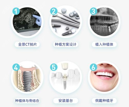 深圳世纪河山口腔种植牙流程