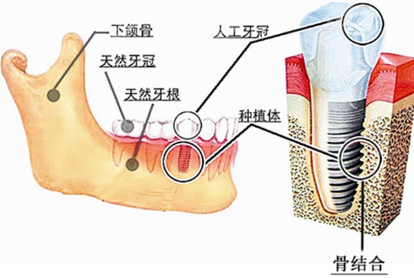 种植体植入牙槽骨的图片