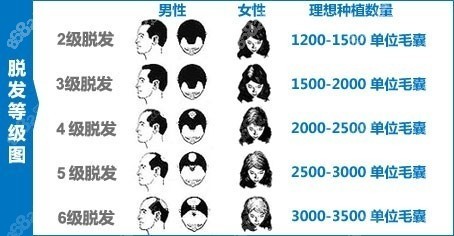 大面积植发种植数量在4000单位以上