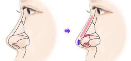 上海李鸿君做鼻子修复案 例示意图参考