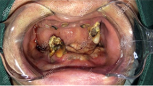大连齿医生口腔全口种牙前