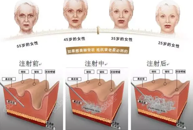 爱贝芙注射图示