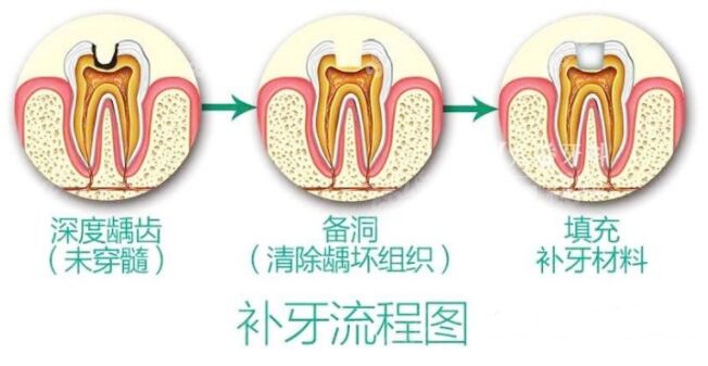 补牙流程图