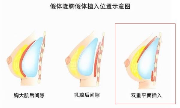 郑州东方整形医院15分钟极速动感丰胸靠谱吗？采用双平面技术挺可靠的