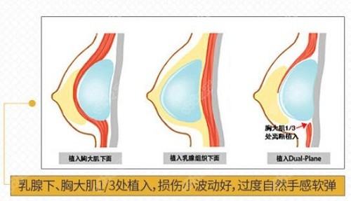 重庆华美丰胸双平面植入技术