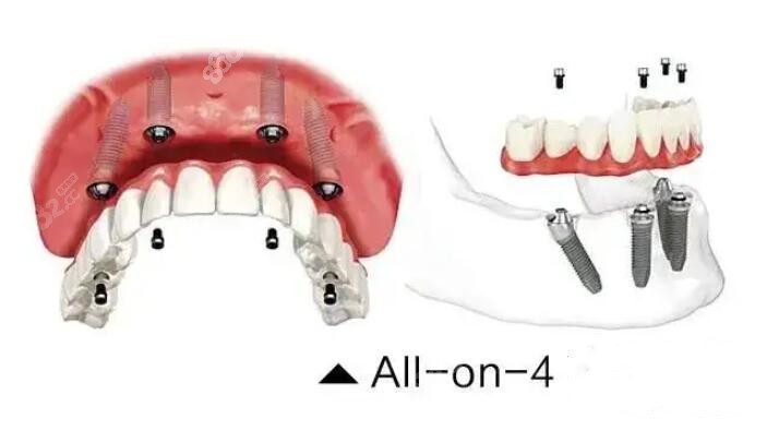 ALL-ON-4种植牙技术