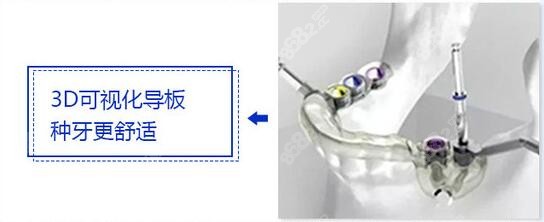 广州广大口腔的数字化种植牙技术