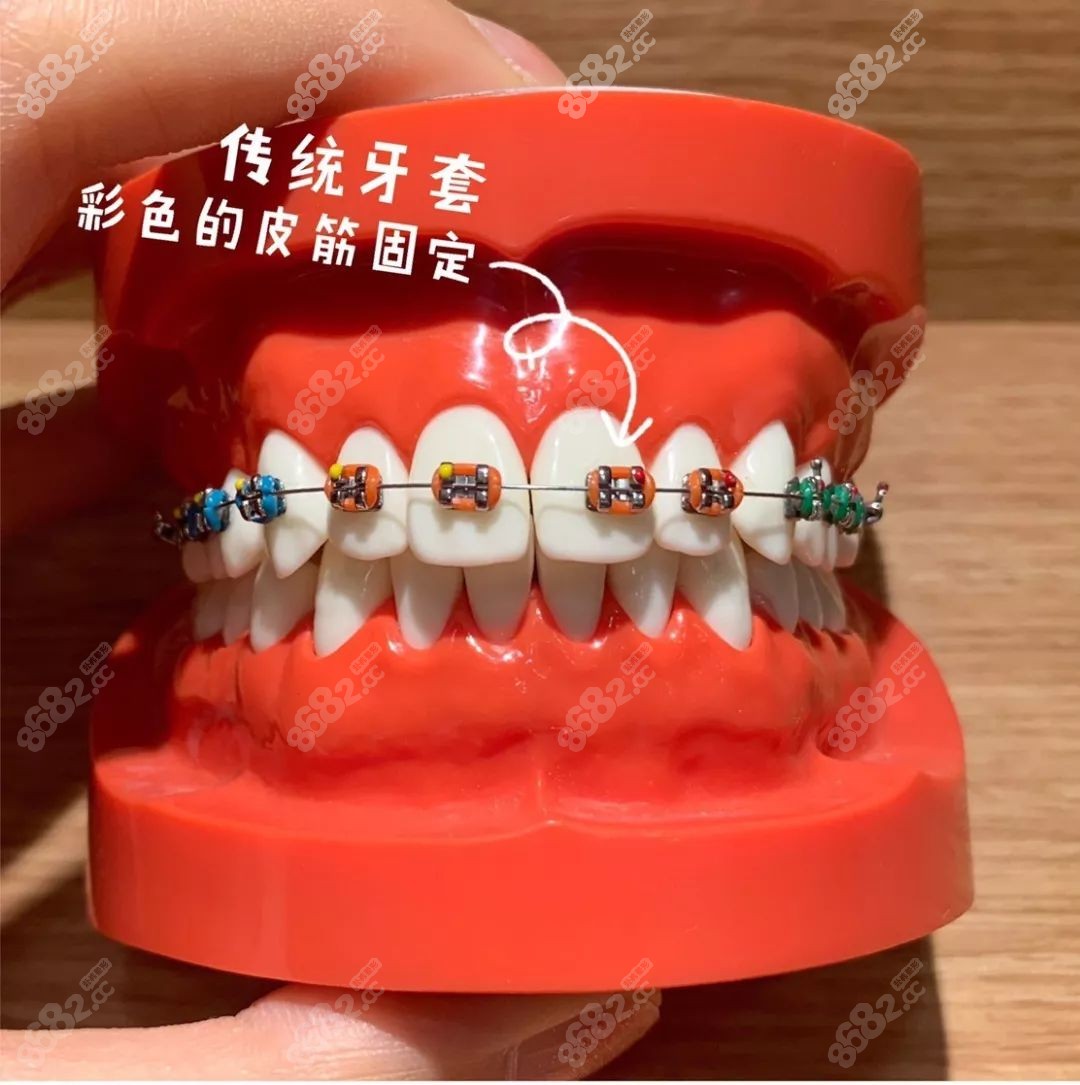 苏州牙齿矫正-进口托槽自锁牙套矫正案例分享 - 知乎