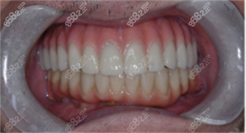 大连齿医生口腔全口种牙后