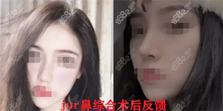 南京jur整形鼻综合整形反馈