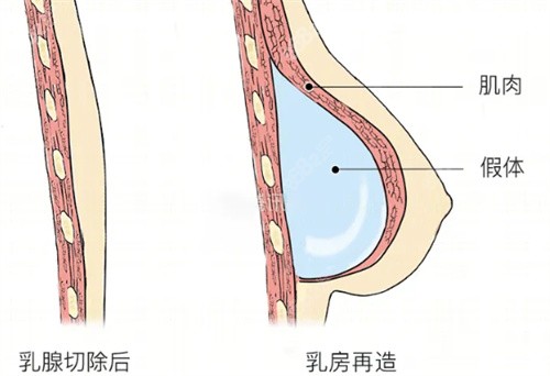 乳房再造示意图