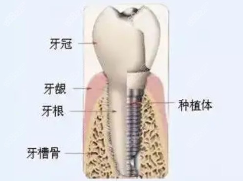 种植牙图解