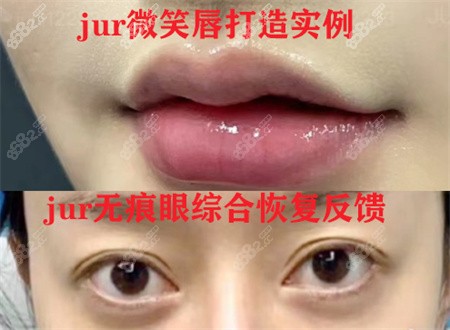 南京jur整形术后反馈