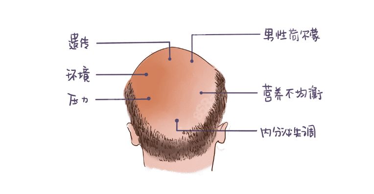 头发大面积稀疏的人做植发先要看剩余资源