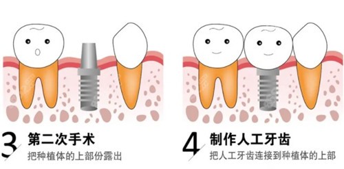 种植牙步骤3-4