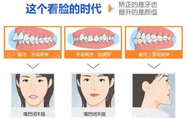 需要做矫正的牙齿症状