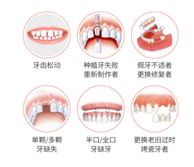 种植牙适合的人群