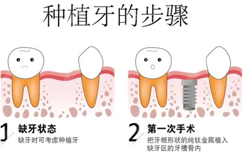 种植牙的步骤1-2