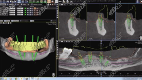 北京佳美口腔医院种植体示意图