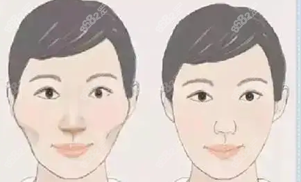 这是颧骨内推5mm的前后对比图