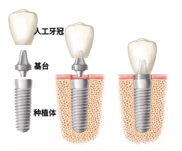 惠州惠阳区一颗种植牙多少钱