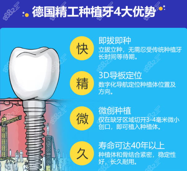 德国种植牙优势