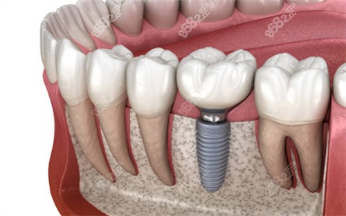 种植牙卡通示意图