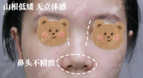 范荣杰做鼻子术前