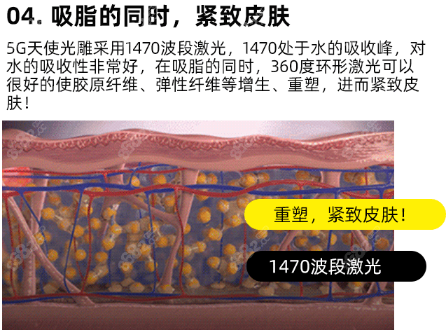 5G天使光雕吸脂优势