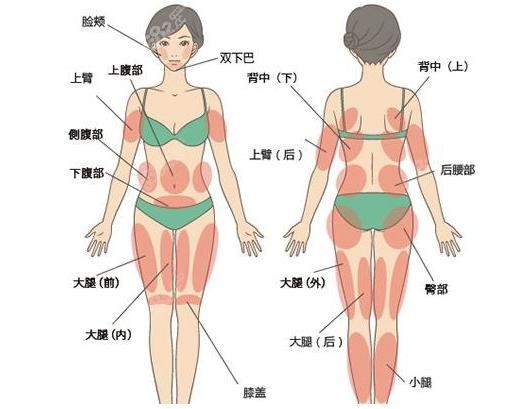 抽脂部位图解